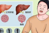 脂肪肝食疗（以饮食调理恢复健康）