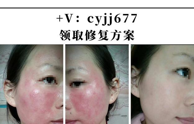 探究皮肤红血丝的成因及预防方法（揭开皮肤红血丝背后的秘密）  第2张