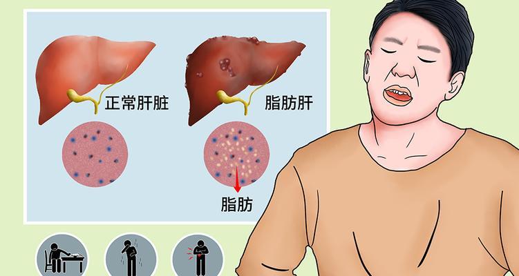 脂肪肝食疗（以饮食调理恢复健康）  第1张