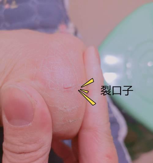 冬季手裂口子的护理方法（保护手部）  第2张
